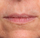  Bandingkan Sebelum & Sesudah Foto Augmentasi Bibir