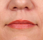  Bandingkan Sebelum & Sesudah Foto Augmentasi Bibir