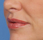  Bandingkan Sebelum & Sesudah Foto Augmentasi Bibir