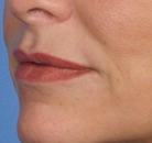  Bandingkan Sebelum & Sesudah Foto Augmentasi Bibir