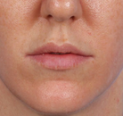  Bandingkan Sebelum & Sesudah Foto Augmentasi Bibir