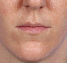  Bandingkan Sebelum & Sesudah Foto Augmentasi Bibir