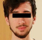  Bandingkan Sebelum & Sesudah Foto Operasi Penggantian Kelamin (Perempuan ke Laki-Laki)