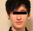  Bandingkan Sebelum & Sesudah Foto Operasi Penggantian Kelamin (Perempuan ke Laki-Laki)