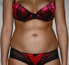 Bandingkan Sebelum & Sesudah Foto Vaser-Liposuction