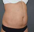 Bandingkan Sebelum & Sesudah Foto Vaser-Liposuction