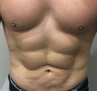 Bandingkan Sebelum & Sesudah Foto Vaser-Liposuction