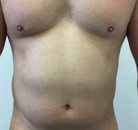 Bandingkan Sebelum & Sesudah Foto Vaser-Liposuction