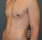Bandingkan Sebelum & Sesudah Foto Vaser-Liposuction