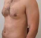 Bandingkan Sebelum & Sesudah Foto Vaser-Liposuction