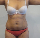 Bandingkan Sebelum & Sesudah Foto Vaser-Liposuction