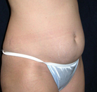Bandingkan Sebelum & Sesudah Foto Vaser-Liposuction