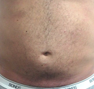 Bandingkan Sebelum & Sesudah Foto Vaser-Liposuction