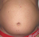 Bandingkan Sebelum & Sesudah Foto Vaser-Liposuction