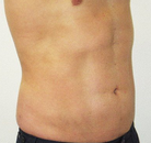 Bandingkan Sebelum & Sesudah Foto Vaser-Liposuction