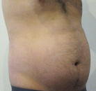 Bandingkan Sebelum & Sesudah Foto Vaser-Liposuction