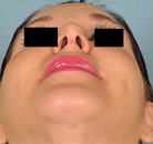 Bandingkan Sebelum & Sesudah Foto Septoplasti