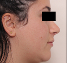 Bandingkan Sebelum & Sesudah Foto Septoplasti
