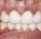 So sánh Ảnh Trước và Sau của Niềng răng không mắc cài Invisalign