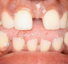 So sánh Ảnh Trước và Sau của Niềng răng không mắc cài Invisalign