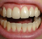 So sánh Ảnh Trước và Sau của Niềng răng không mắc cài Invisalign