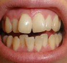 So sánh Ảnh Trước và Sau của Niềng răng không mắc cài Invisalign