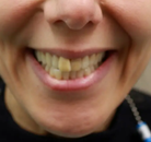 So sánh Ảnh Trước và Sau của Niềng răng không mắc cài Invisalign