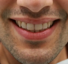 So sánh Ảnh Trước và Sau của Niềng răng không mắc cài Invisalign