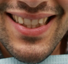 So sánh Ảnh Trước và Sau của Niềng răng không mắc cài Invisalign