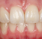 So sánh Ảnh Trước và Sau của Niềng răng không mắc cài Invisalign