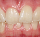 So sánh Ảnh Trước và Sau của Niềng răng không mắc cài Invisalign