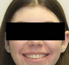 So sánh Ảnh Trước và Sau của Niềng răng không mắc cài Invisalign