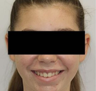 So sánh Ảnh Trước và Sau của Niềng răng không mắc cài Invisalign