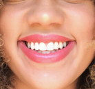 So sánh Ảnh Trước và Sau của Niềng răng