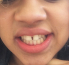 So sánh Ảnh Trước và Sau của Niềng răng