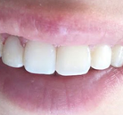 So sánh Ảnh Trước và Sau của Niềng răng