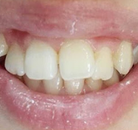 So sánh Ảnh Trước và Sau của Niềng răng