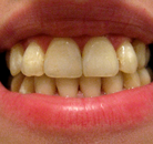 So sánh Ảnh Trước và Sau của Niềng răng