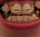 So sánh Ảnh Trước và Sau của Niềng răng