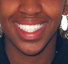 So sánh Ảnh Trước và Sau của Niềng răng