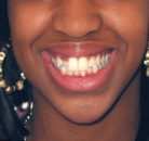 So sánh Ảnh Trước và Sau của Niềng răng