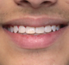 So sánh Ảnh Trước và Sau của Niềng răng