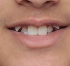 So sánh Ảnh Trước và Sau của Niềng răng