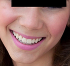 So sánh Ảnh Trước và Sau của Niềng răng