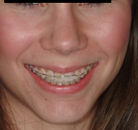 So sánh Ảnh Trước và Sau của Niềng răng
