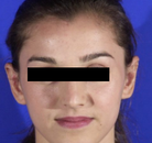  Bandingkan Sebelum & Sesudah Foto Otoplasty