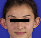  Bandingkan Sebelum & Sesudah Foto Otoplasty