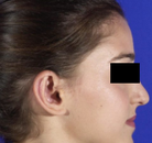  Bandingkan Sebelum & Sesudah Foto Otoplasty