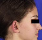  Bandingkan Sebelum & Sesudah Foto Otoplasty