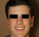  Bandingkan Sebelum & Sesudah Foto Otoplasty